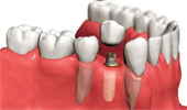 Имплантация зубов или современный способ сохранить красоту улыбки