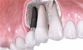 Зубные импланты: виды и показания к установке, противопоказания