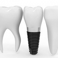Имплантация зубов: процедуры, технологии, достоинства и риски